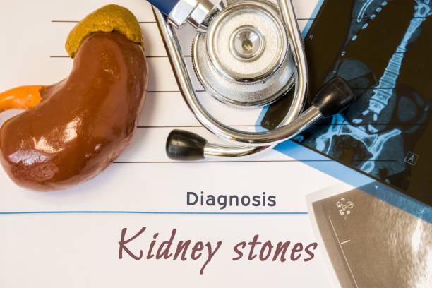 drhoseini.net/kidney_stones.html دکتر سید مصطفی حسینی -سنگهاى ادرارى