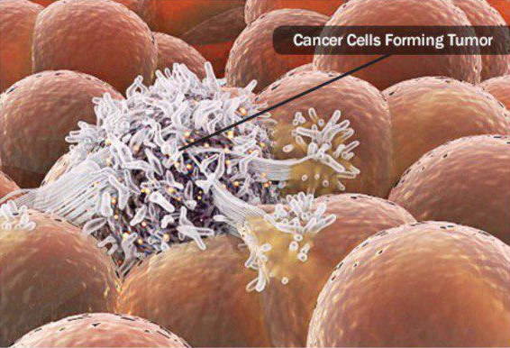 drhoseini.net/Testical_Cancer.html علائم-علل-سرطان بیضه-دکتر سید مصطفی حسنی -دکتر ارولوژیست
